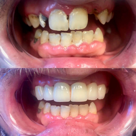 before and after dental services of a mouth with cavities