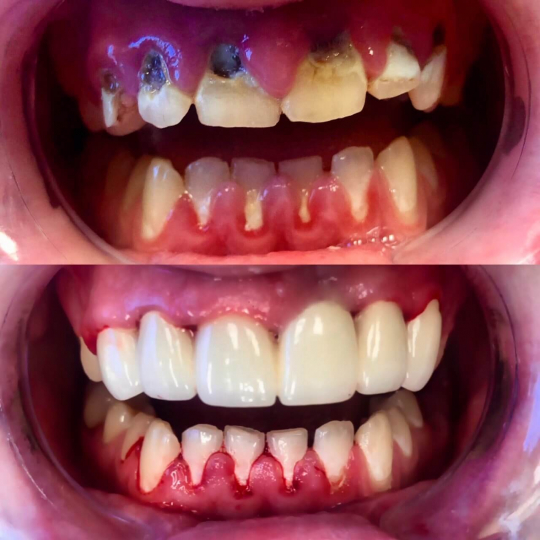 before and after photo of teeth that received dental work