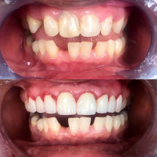 before and after photo of brightened teeth