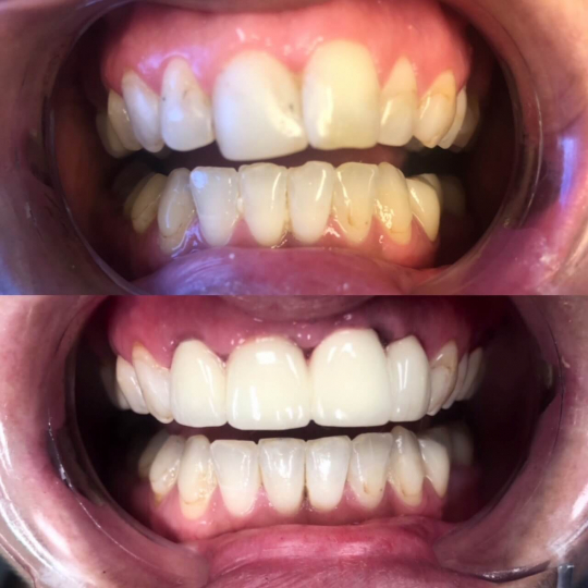 before and after photo of dental services performed