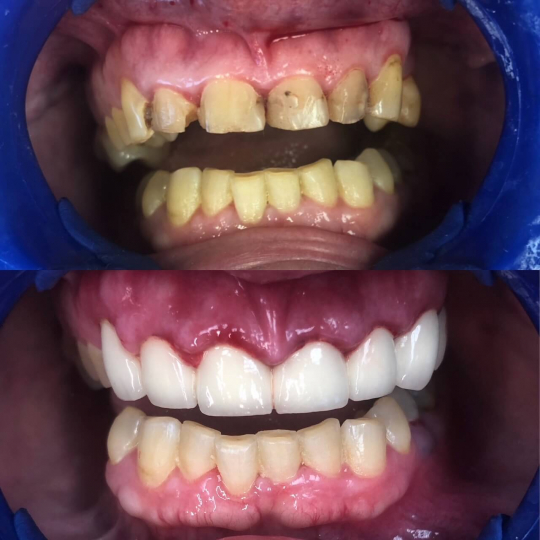 before and after photo of teeth brightened with dental services