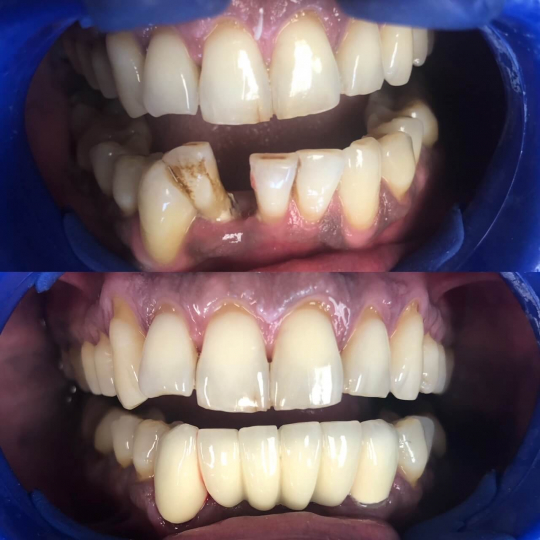 before and after photo of teeth on bottom replaced