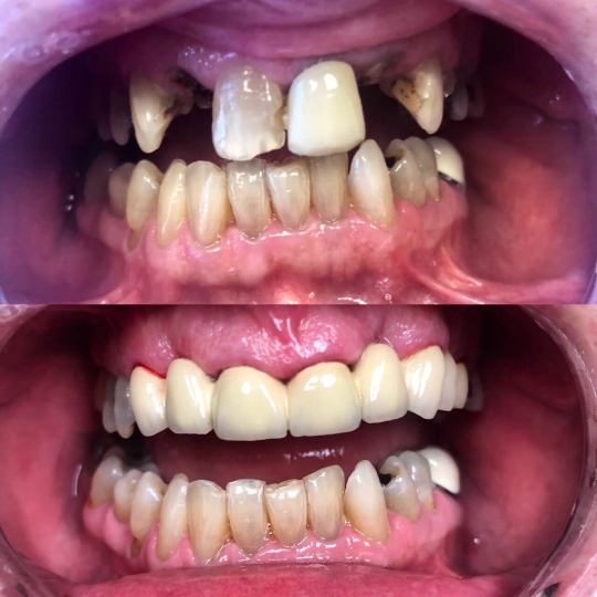 before and after photo of improved dental work