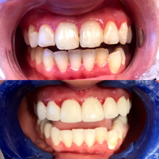 before and after photo of improved teeth and smile