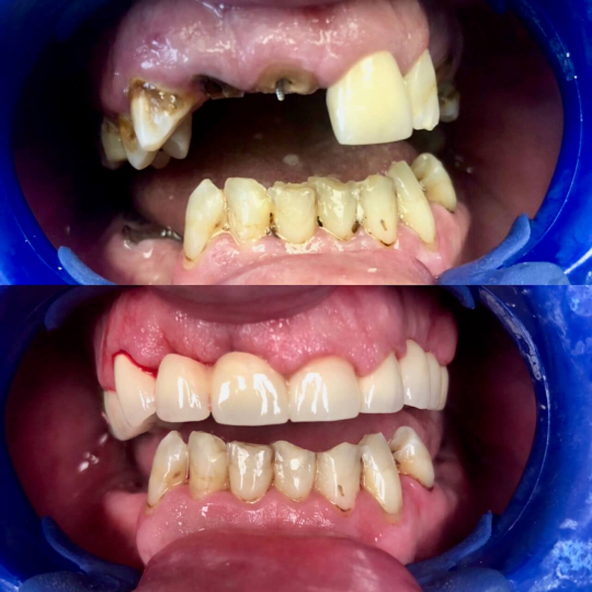 before and after photo of teeth replaced on top of mouth