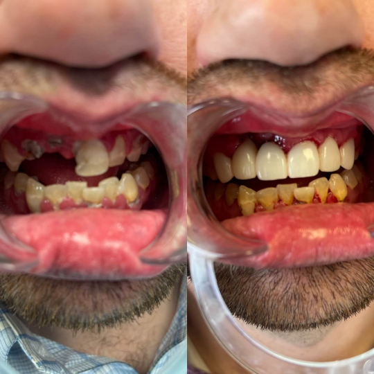 before and after photo of top teeth