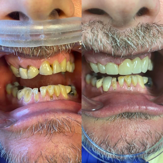 before and after photo of dental services
