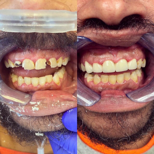 before and after photo of top teeth restoration