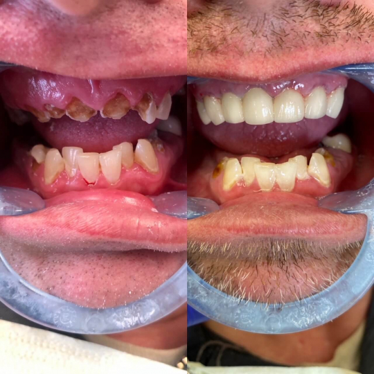 before and after photo of dental restoration
