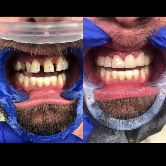 before and after photo of teeth restored