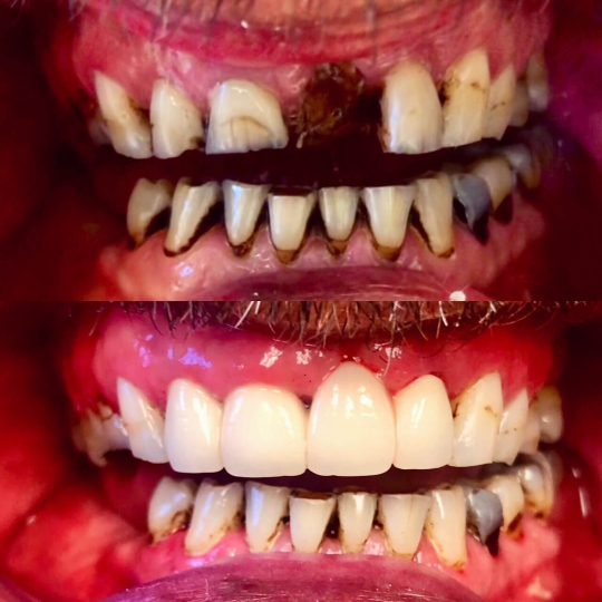 before and after photo of teeth replacement