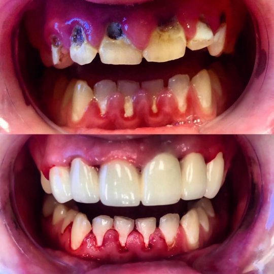 before and after photo of teeth treated with dental services