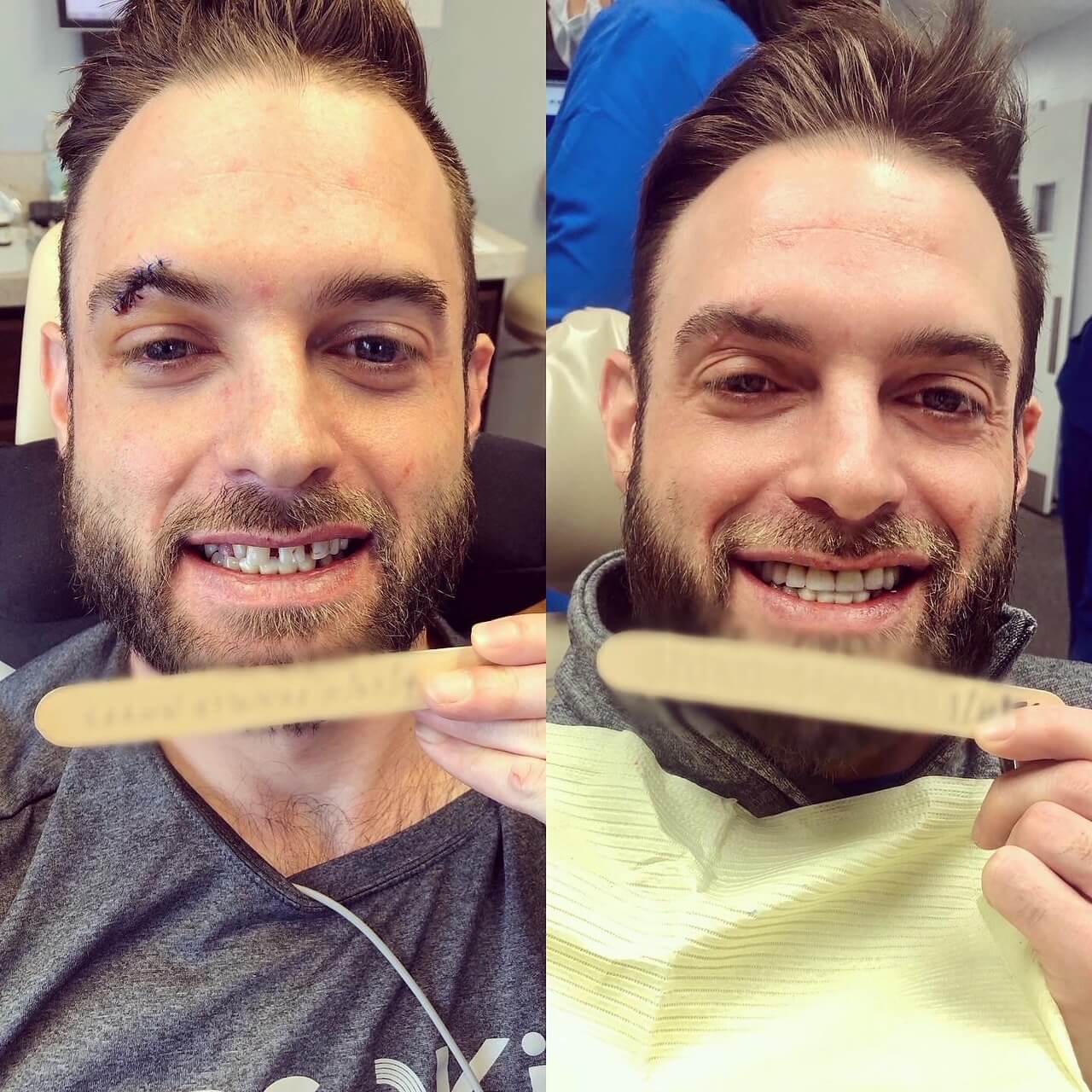 before and after photo of man who received dental work