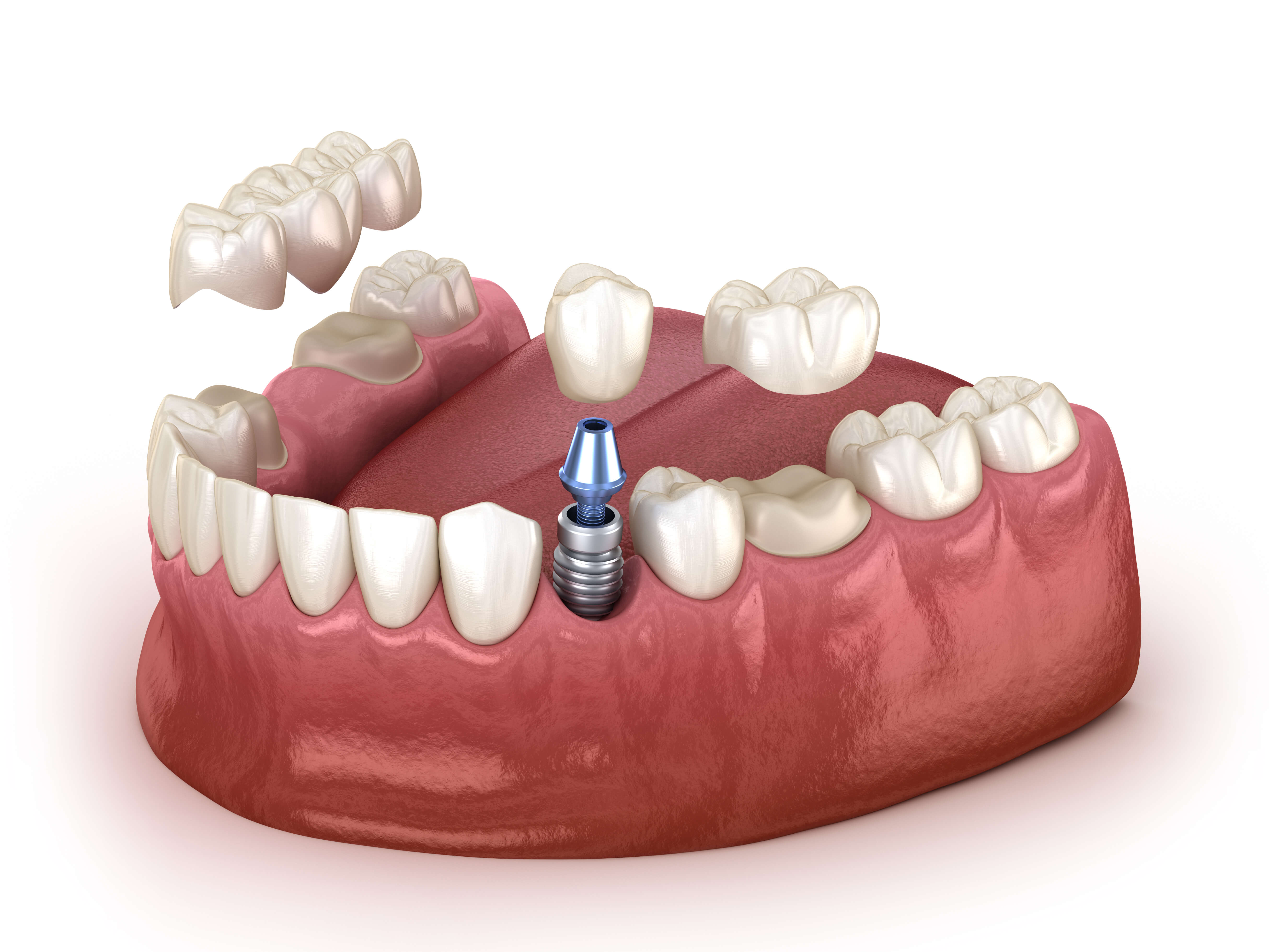 model of dental implant vs bridge to correct missing teeth